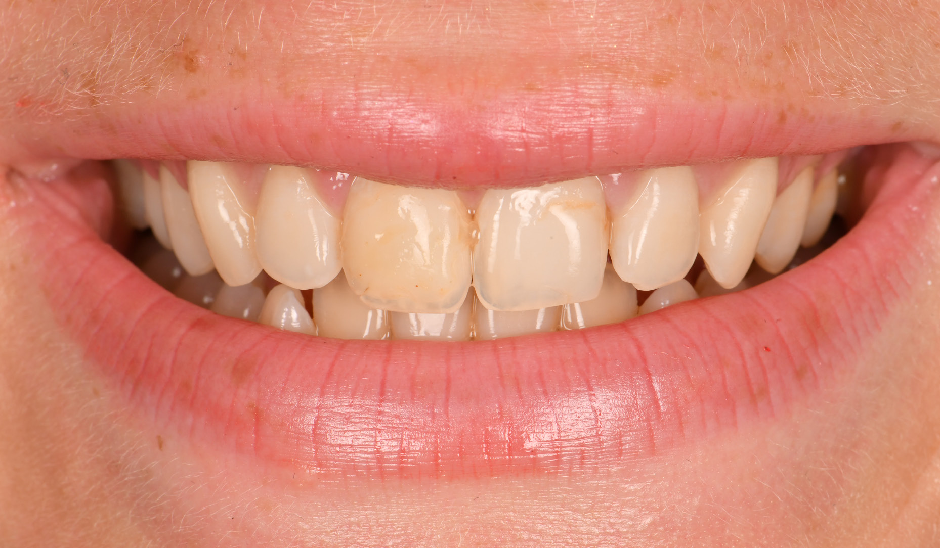 Figure 1: Pre-operative unrestricted smile 1:2 ratio view, teeth 1.1 and 2.1 with old, defective composite restorations with excessive chroma